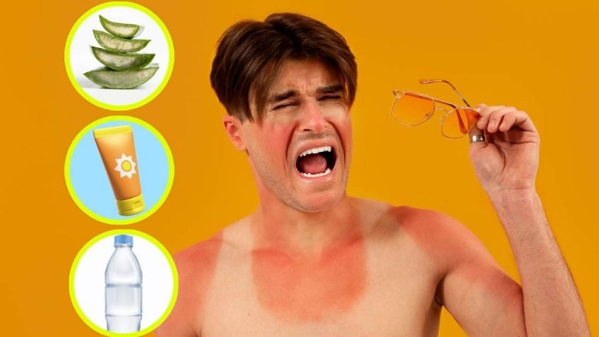 ¿Cómo aliviar los síntomas de las quemaduras por el sol? ¿Cómo aliviar los síntomas de las quemaduras por el sol?