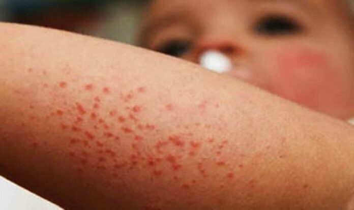 Acumula Veracruz 72 casos de sarampión en el año Acumula Veracruz 72 casos de sarampión en el año